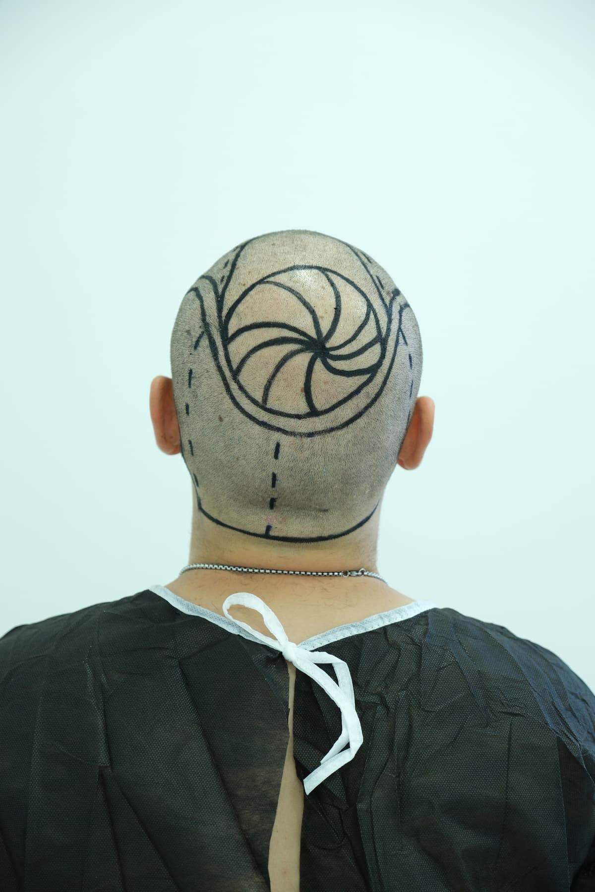 360 Vertex Hair Transplantation