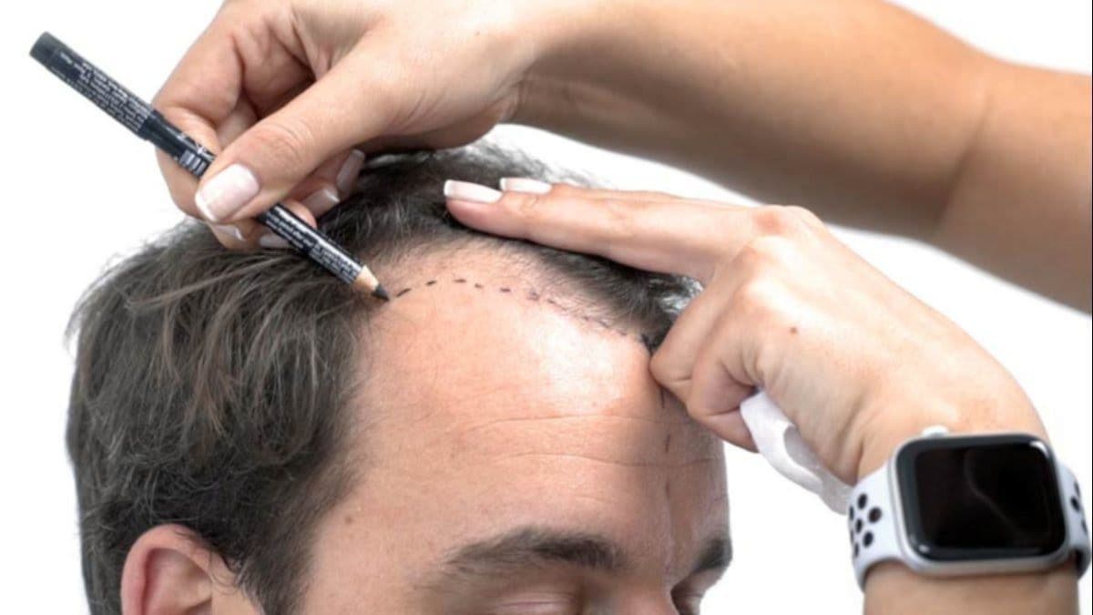 Shaving-Free Hair Transplantation
