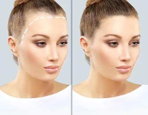 Hair Transplantation for Women