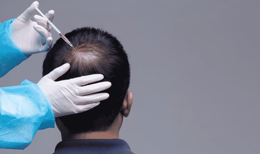 Cell Hair Transplantation